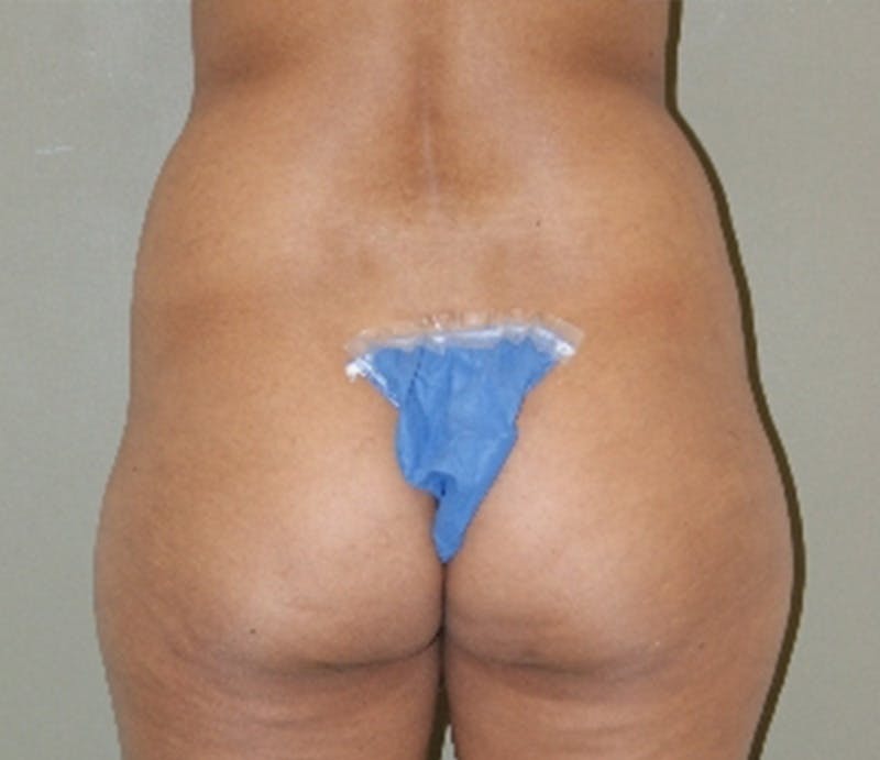 Abdominoplasty Before & After Gallery - Patient 325453 - Image 5