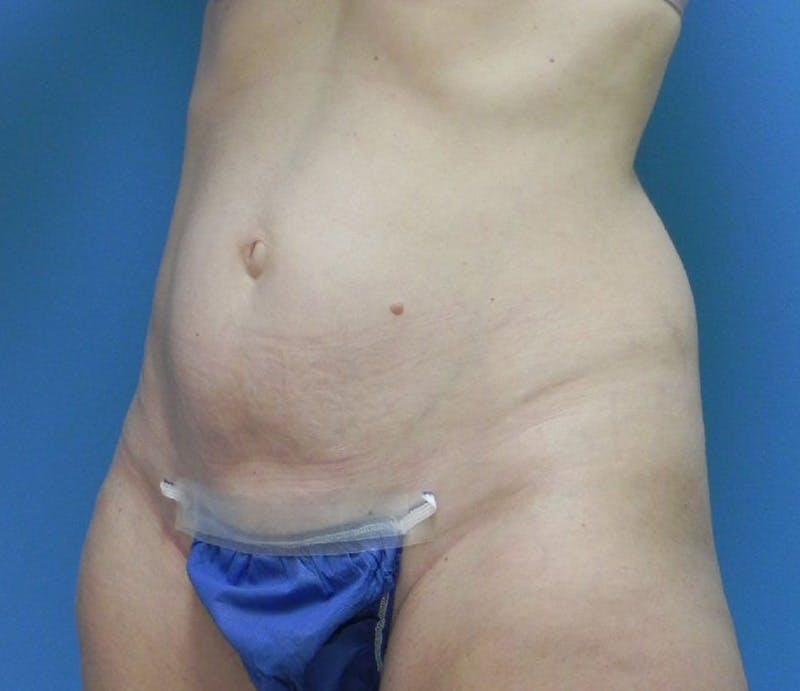Abdominoplasty Before & After Gallery - Patient 863683 - Image 3