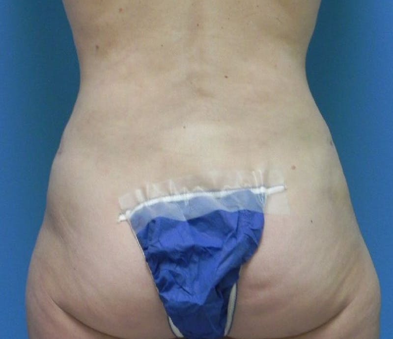 Abdominoplasty Before & After Gallery - Patient 863683 - Image 6