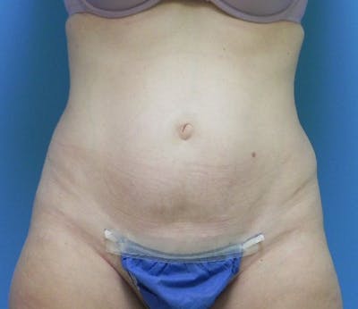 Abdominoplasty Before & After Gallery - Patient 863683 - Image 1