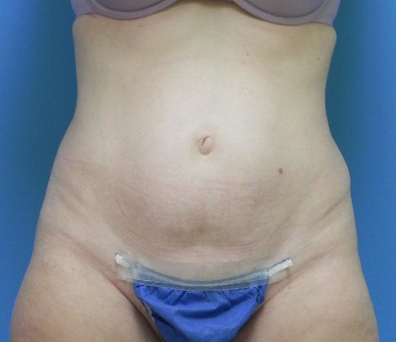 Abdominoplasty Before & After Gallery - Patient 863683 - Image 1