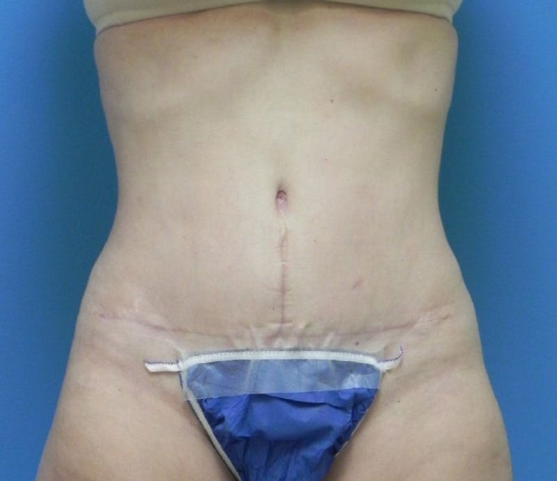 Abdominoplasty Before & After Gallery - Patient 863683 - Image 2