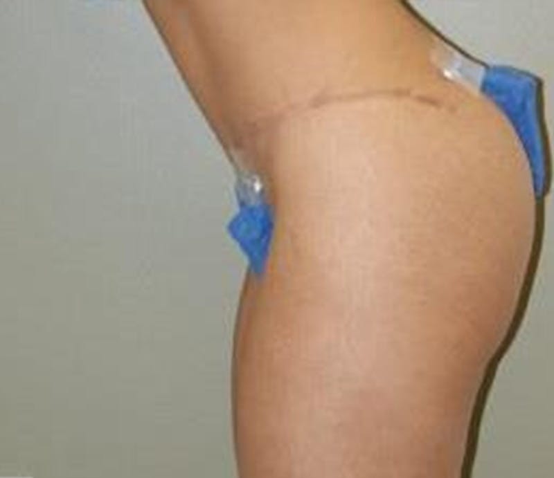 Abdominoplasty Before & After Gallery - Patient 194413 - Image 6