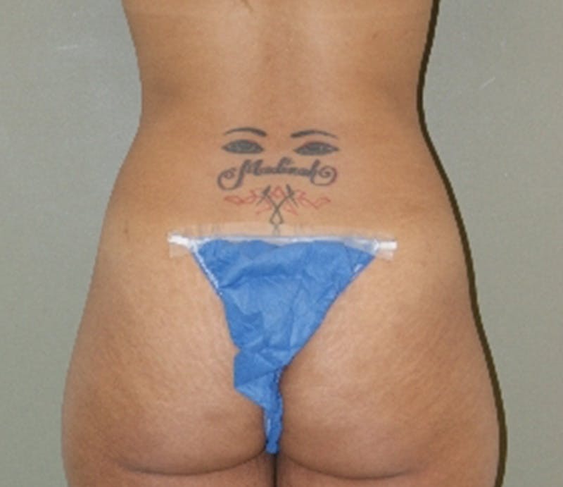 Abdominoplasty Before & After Gallery - Patient 194413 - Image 7
