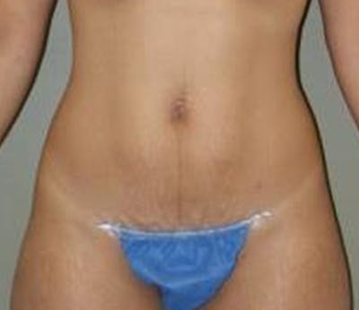 Abdominoplasty Before & After Gallery - Patient 194413 - Image 1