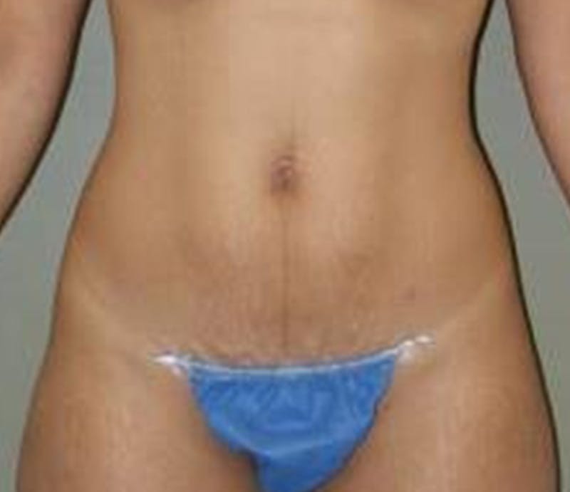 Abdominoplasty Before & After Gallery - Patient 194413 - Image 1