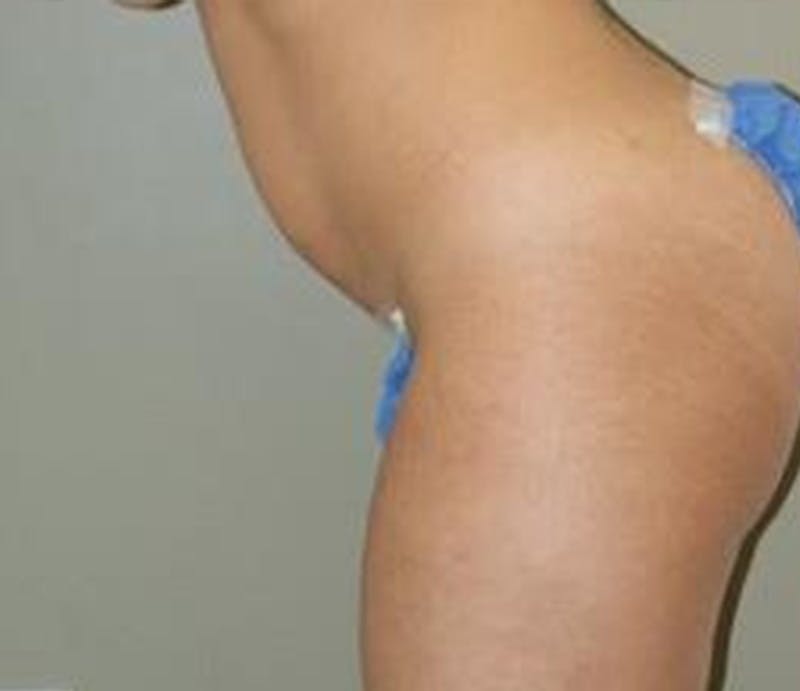 Abdominoplasty Before & After Gallery - Patient 194413 - Image 5