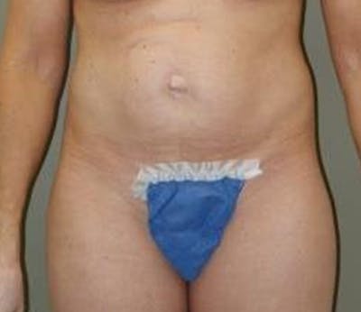Abdominoplasty Before & After Gallery - Patient 284454 - Image 1