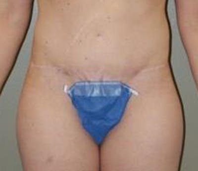 Abdominoplasty Before & After Gallery - Patient 284454 - Image 2
