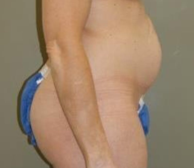 Abdominoplasty Before & After Gallery - Patient 284454 - Image 5