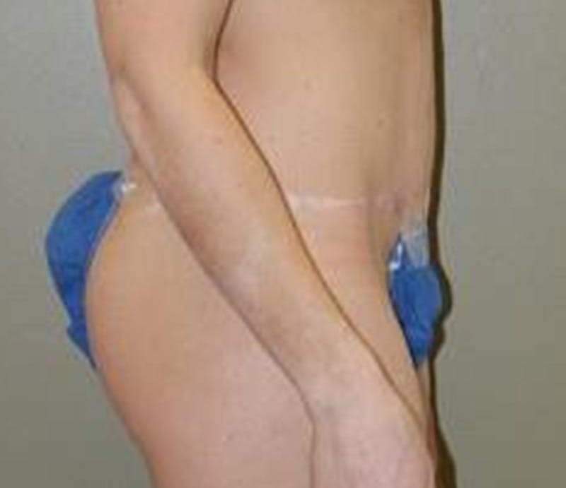 Abdominoplasty Before & After Gallery - Patient 284454 - Image 6