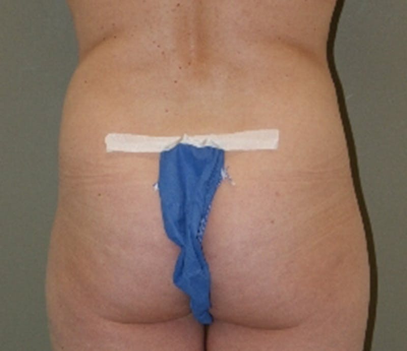 Abdominoplasty Before & After Gallery - Patient 284454 - Image 7