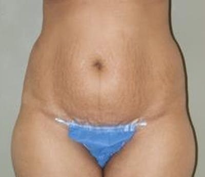 Abdominoplasty Before & After Gallery - Patient 382915 - Image 1
