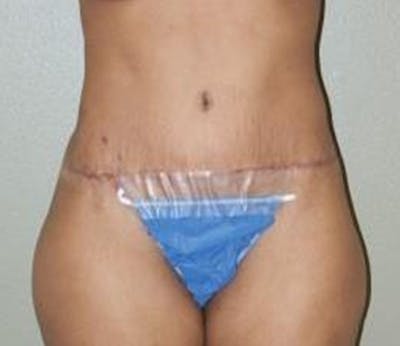 Abdominoplasty Before & After Gallery - Patient 382915 - Image 2