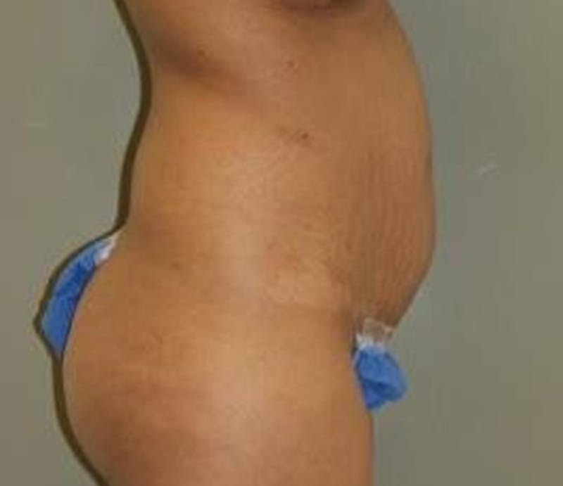 Abdominoplasty Before & After Gallery - Patient 382915 - Image 3
