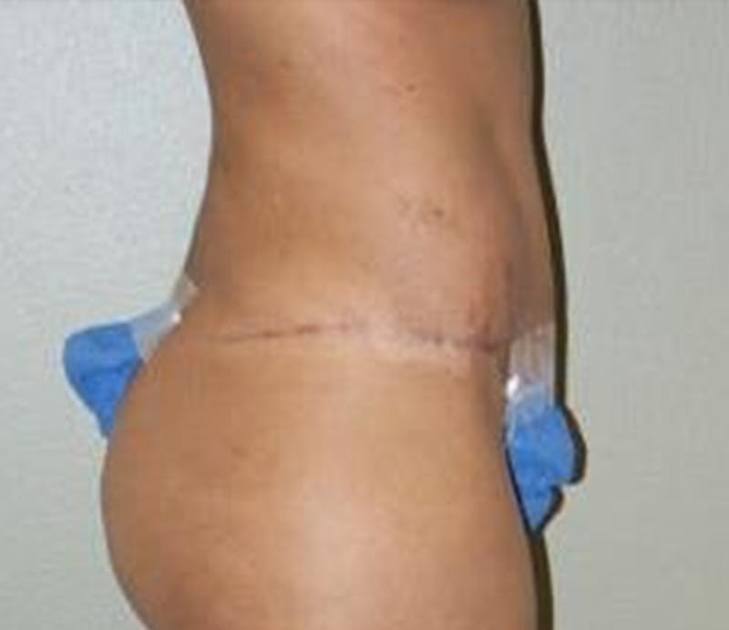Abdominoplasty Before & After Gallery - Patient 382915 - Image 4