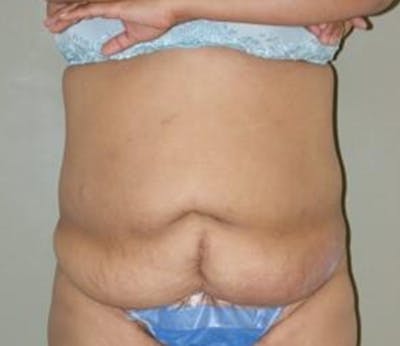 Abdominoplasty Before & After Gallery - Patient 163925 - Image 1