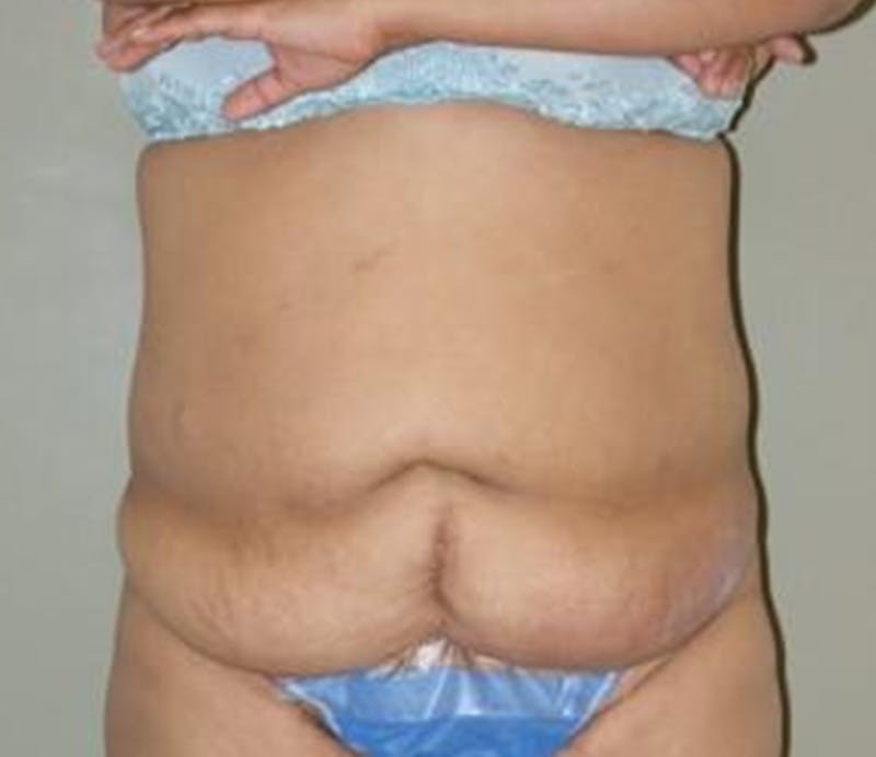 Abdominoplasty Before & After Gallery - Patient 163925 - Image 1