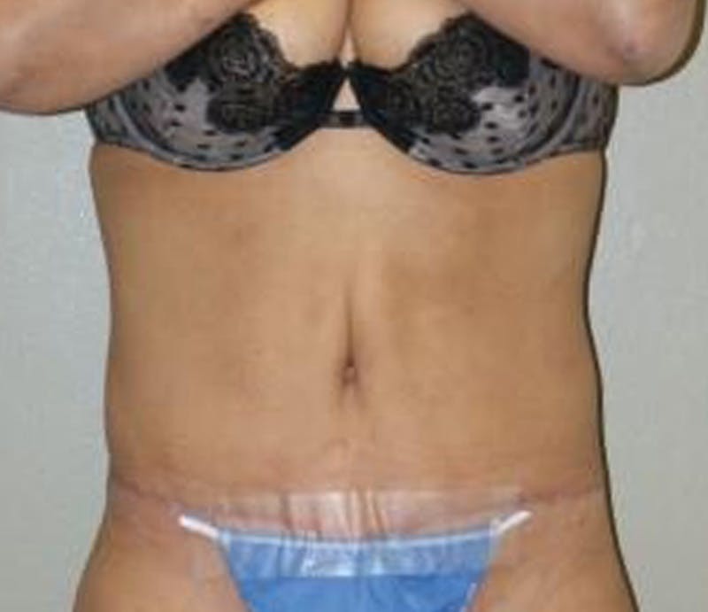 Abdominoplasty Before & After Gallery - Patient 163925 - Image 2