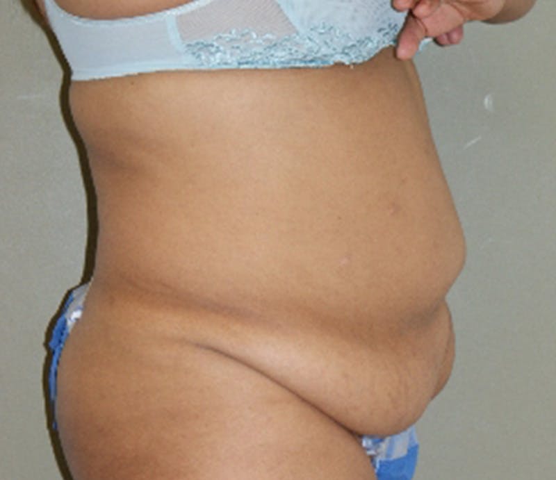 Abdominoplasty Before & After Gallery - Patient 163925 - Image 3