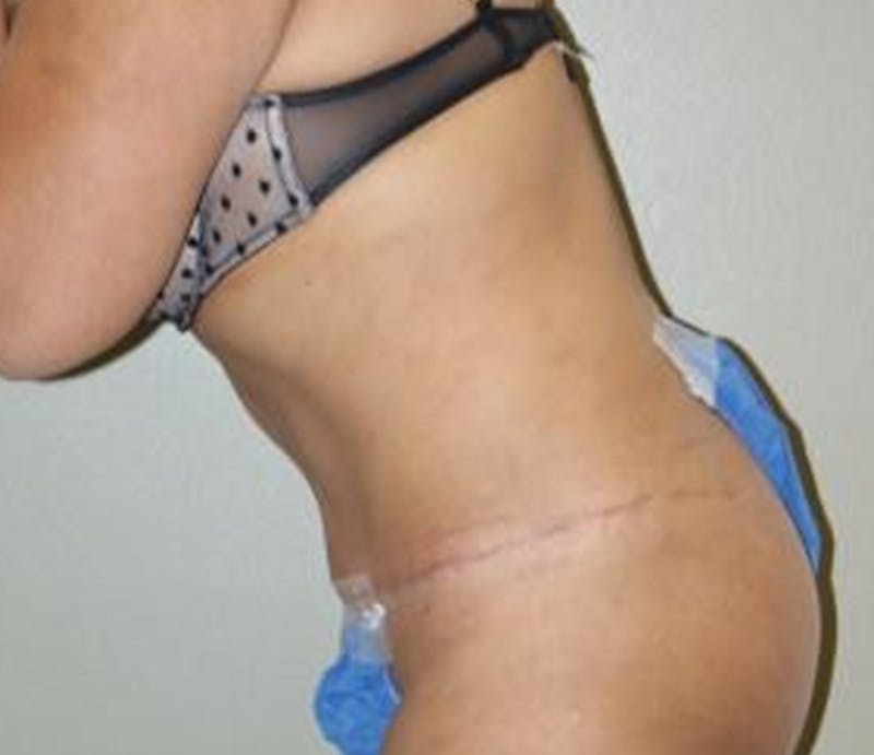 Abdominoplasty Before & After Gallery - Patient 163925 - Image 6