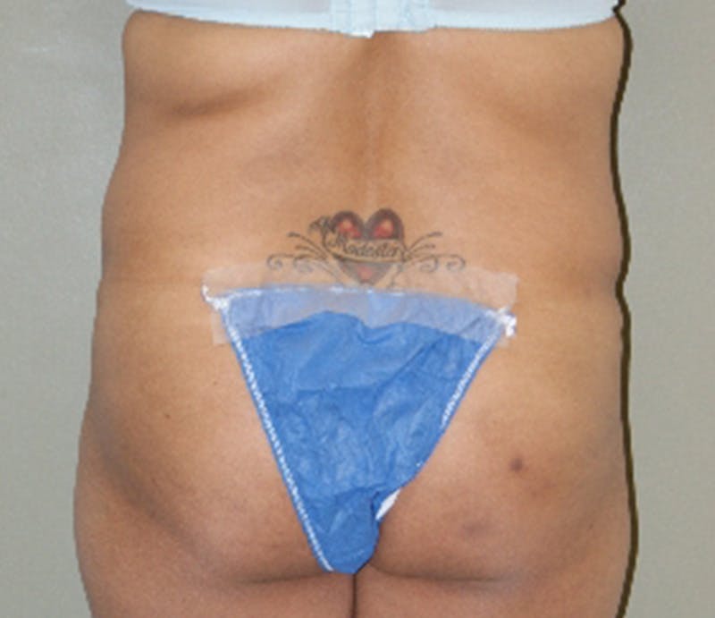 Abdominoplasty Before & After Gallery - Patient 163925 - Image 7