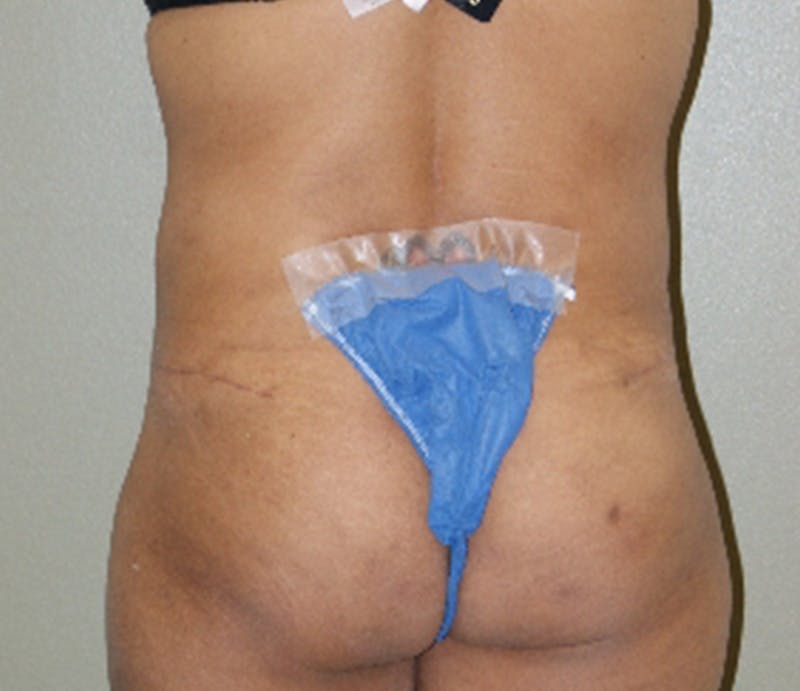 Abdominoplasty Before & After Gallery - Patient 163925 - Image 8