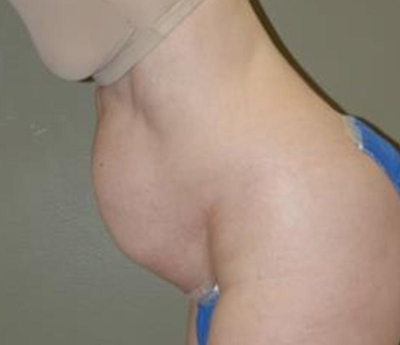 Abdominoplasty Before & After Gallery - Patient 396593 - Image 3