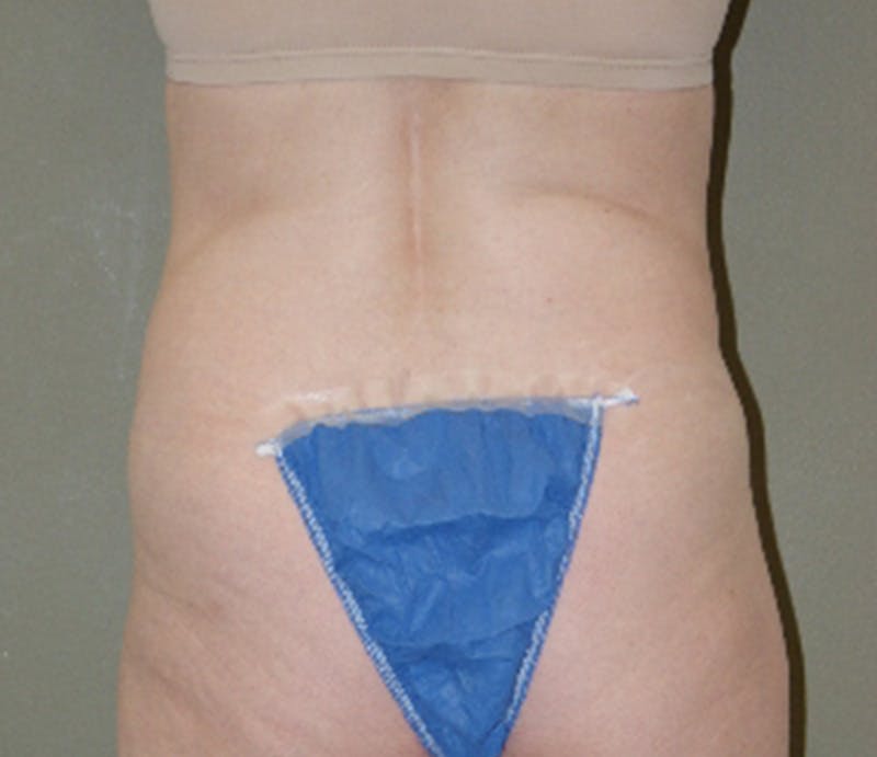 Abdominoplasty Before & After Gallery - Patient 396593 - Image 5
