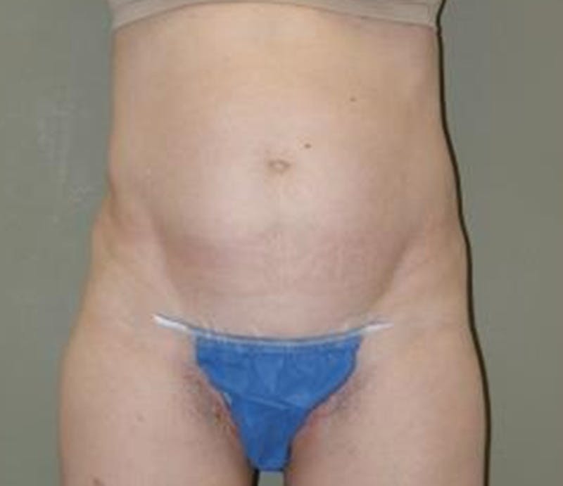Abdominoplasty Before & After Gallery - Patient 396593 - Image 1