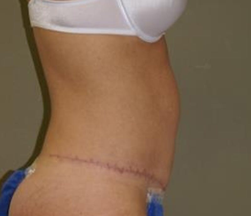 Abdominoplasty Before & After Gallery - Patient 421435 - Image 4