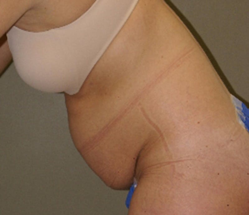 Abdominoplasty Before & After Gallery - Patient 421435 - Image 5