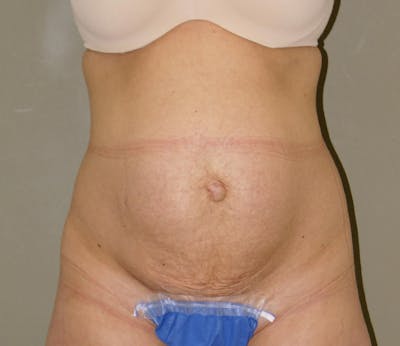 Abdominoplasty Before & After Gallery - Patient 421435 - Image 1