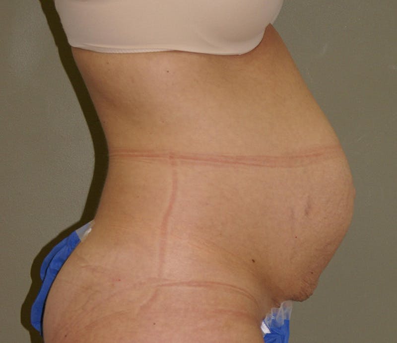 Abdominoplasty Before & After Gallery - Patient 421435 - Image 3
