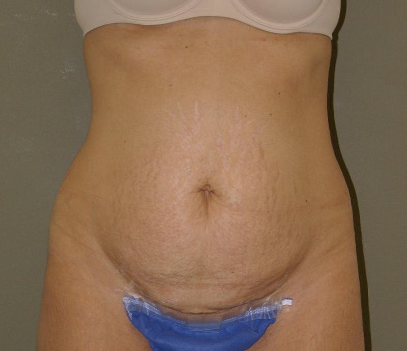 Abdominoplasty Before & After Gallery - Patient 927469 - Image 1