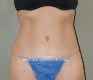 Abdominoplasty Before & After Gallery - Patient 927469 - Image 2