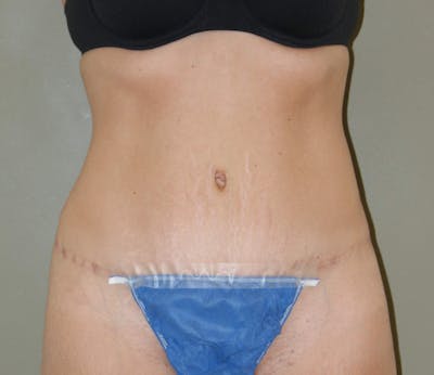 Abdominoplasty Before & After Gallery - Patient 927469 - Image 2