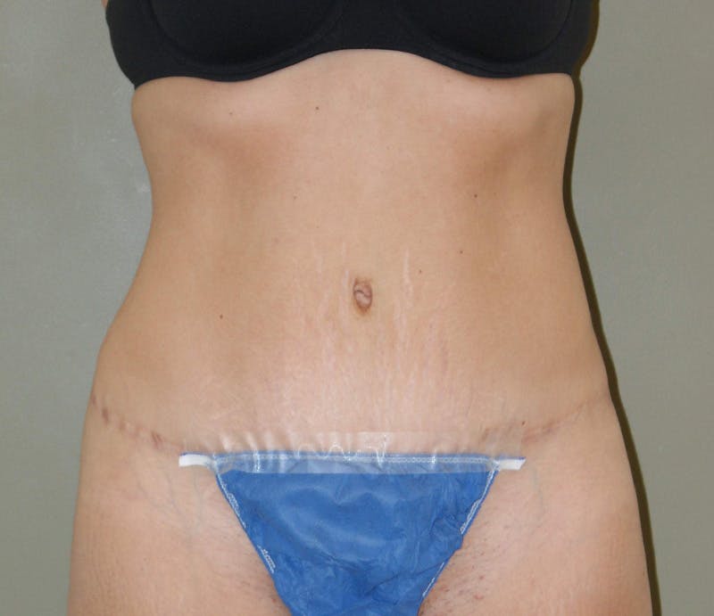 Abdominoplasty Before & After Gallery - Patient 927469 - Image 2
