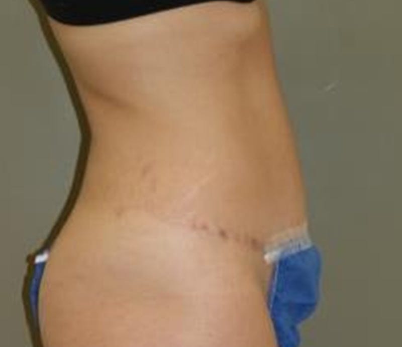 Abdominoplasty Before & After Gallery - Patient 927469 - Image 4