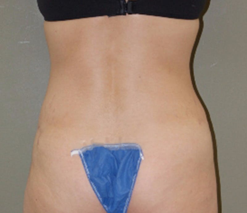 Abdominoplasty Before & After Gallery - Patient 927469 - Image 8