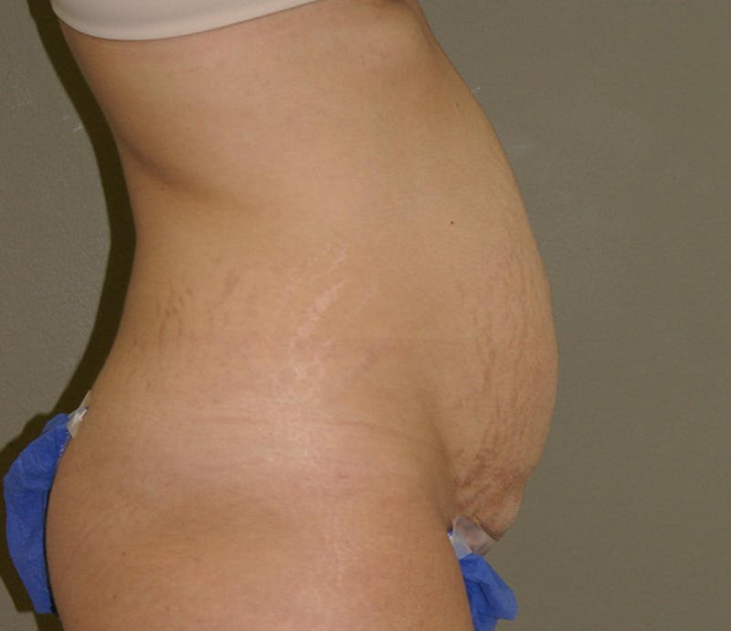 Abdominoplasty Before & After Gallery - Patient 927469 - Image 3