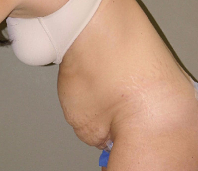 Abdominoplasty Before & After Gallery - Patient 927469 - Image 5