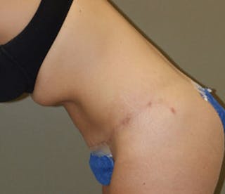 Abdominoplasty Before & After Gallery - Patient 927469 - Image 6