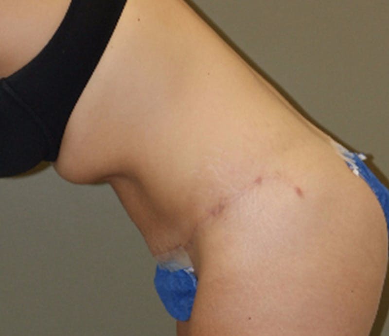 Abdominoplasty Before & After Gallery - Patient 927469 - Image 6