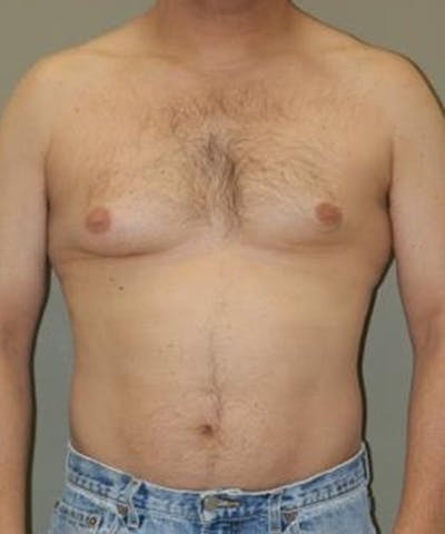 Gynecomastia Reduction Before & After Gallery - Patient 406141 - Image 1