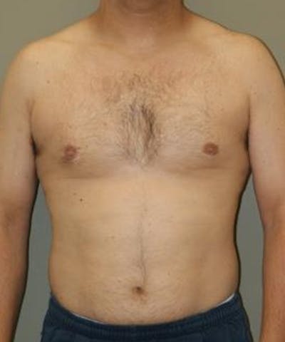 Gynecomastia Reduction Before & After Gallery - Patient 406141 - Image 2