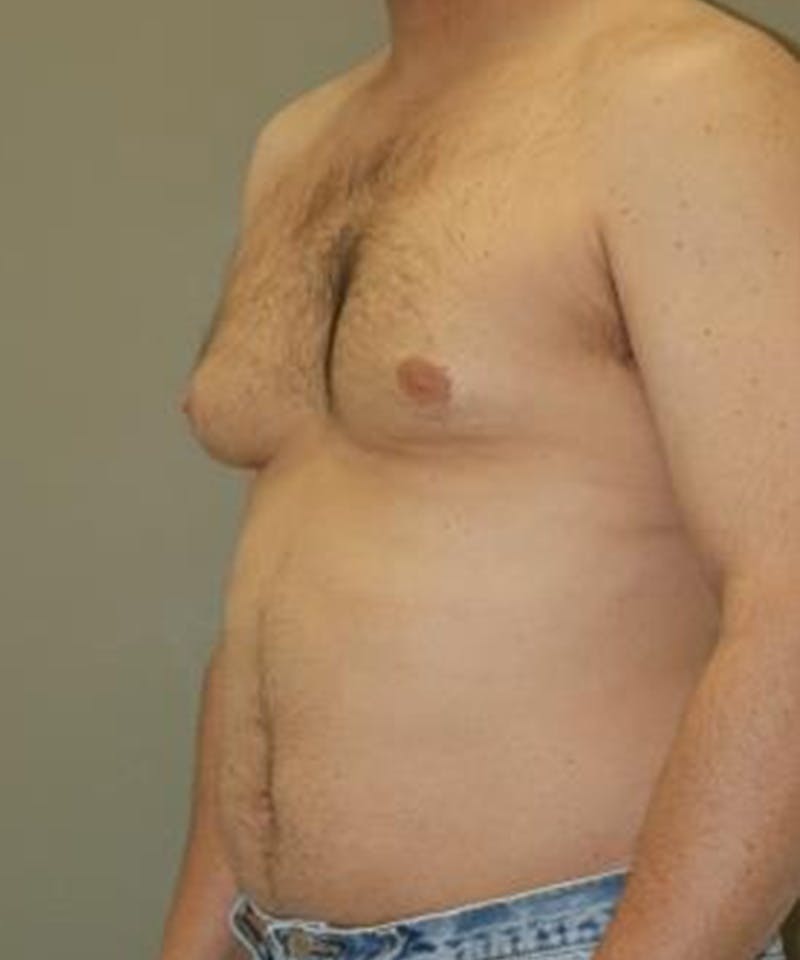 Gynecomastia Reduction Before & After Gallery - Patient 406141 - Image 3