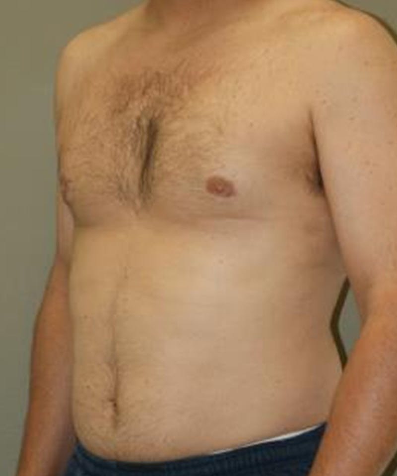 Gynecomastia Reduction Before & After Gallery - Patient 406141 - Image 4