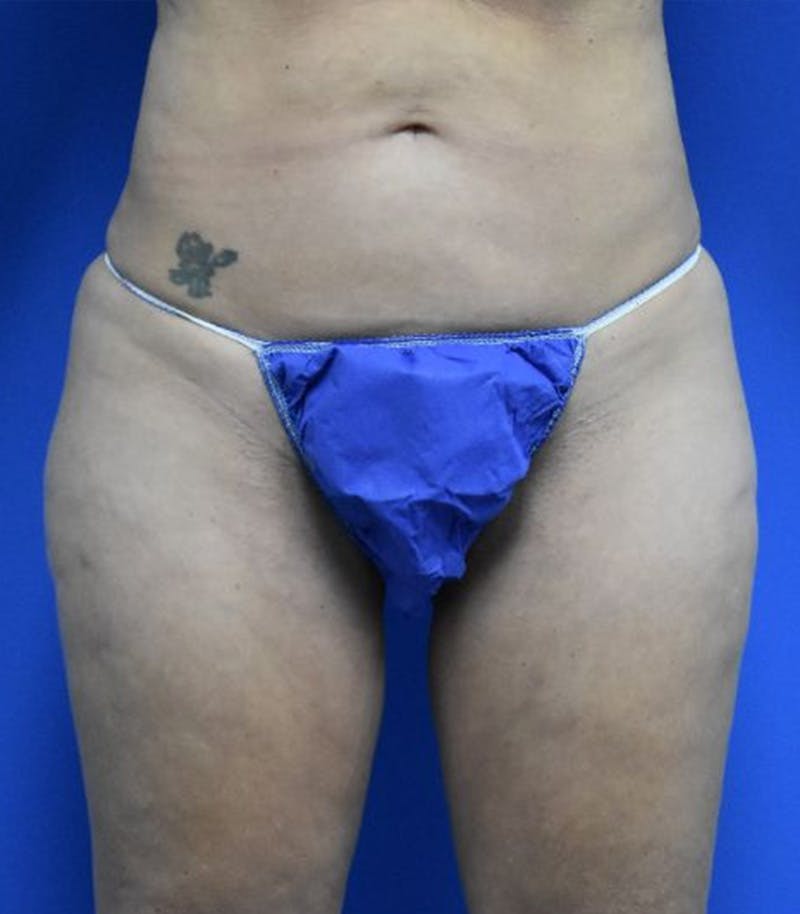 Thigh Lift Before & After Gallery - Patient 366129 - Image 1