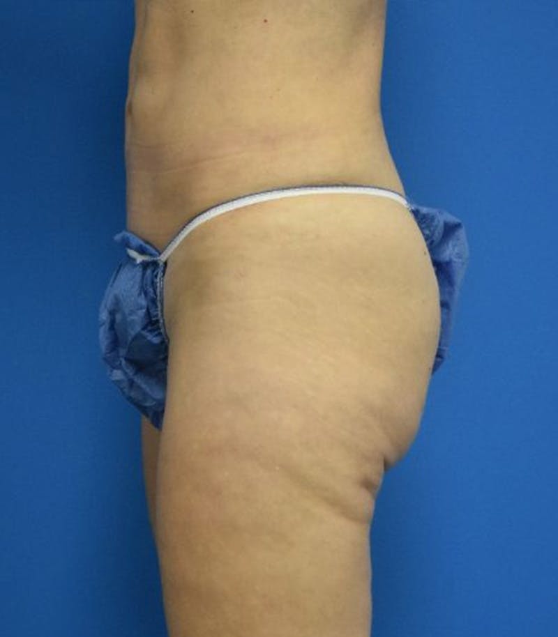 Thigh Lift Before & After Gallery - Patient 366129 - Image 6